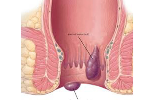 Hemorrhoids are also known as piles